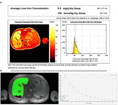 A multicenter study on the quantification of liver iron concentration in thalassemia patients by means of the MRI T2* technique